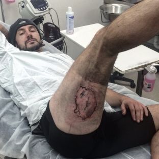 Pëson djegie të shkallës së tretë nga eksplodimi i iPhone 6