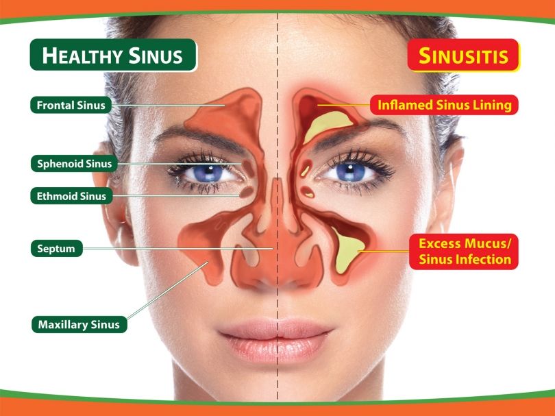 Antibiotikët nuk shërojnë inflamacionin e sinuseve