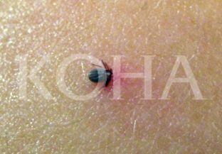  Brenda tre muajsh, 112 raste me ethe hemorragjike 